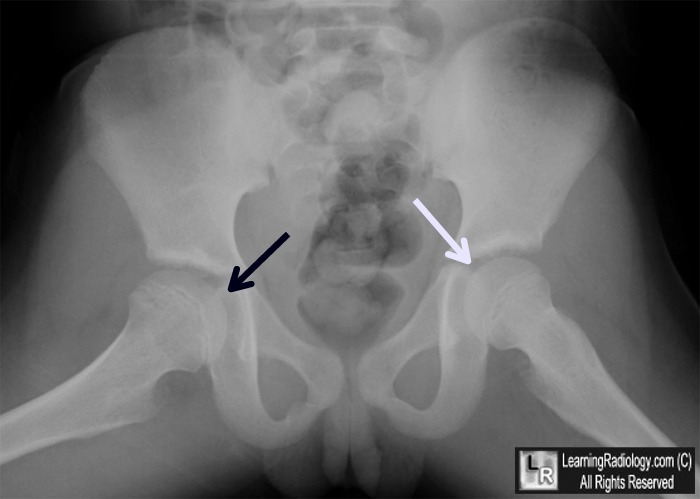 legg calve perthes disease